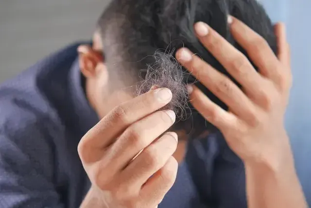 Homem coloca as mãos na cabeça e mostra um tufo de cabelos. A imagem representa a alopecia androgenética.