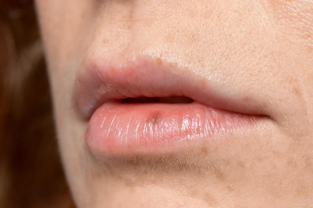 Mulher apresenta herpes nos lábios.