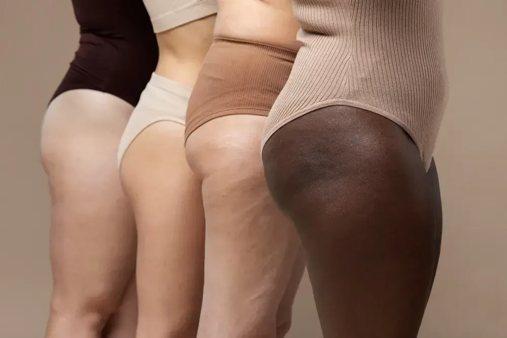 Diversas mulheres apresentam sinais de lipedema nos quadris
