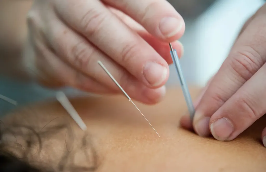 Imagem de procedimento de acupuntura representa prática de medicina integrativa.
