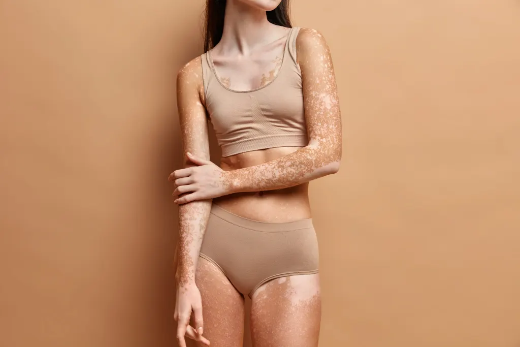 O que é vitiligo? mulher com vitiligo usa lingerie em imagem.